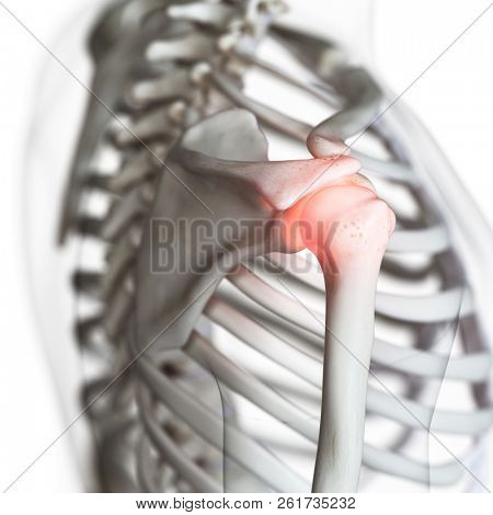 3d rendered medically accurate illustration of a painful shoulder joint