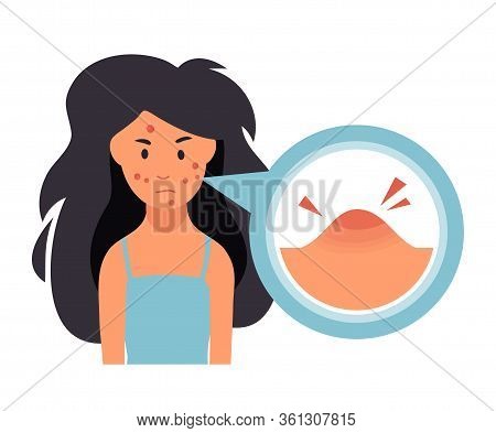 Acne Treatment. Unhappy Girl Struggling With Acne, Pimples. Skin Face Irritation Problem.