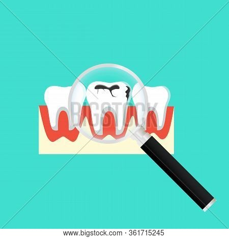 Caries Dental Problems. Tooth With Caries Icon With Magnifier. Big Hole In The Human Teeth On Isolat