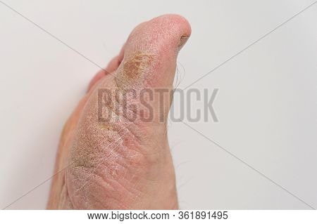 Fungus Of The Foot Of A Person. Close-up. Isolate