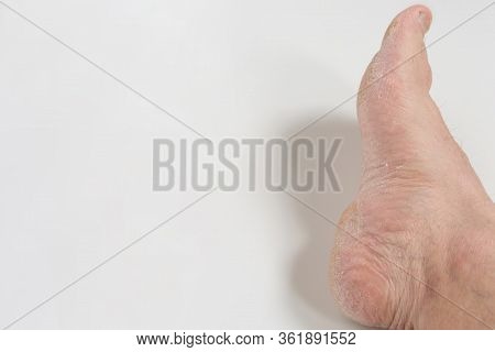 Fungus Of The Foot Of A Person.