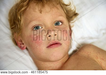 Face Of A Cute Boy Lying In Bed And Suffering From A Serious Illness On The Skin. A Strong Allergic 