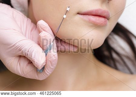 Face Lifting Pdo Suture Operation. Innovative Technique Of New Thread Lift, Cosmetologist Preparing 