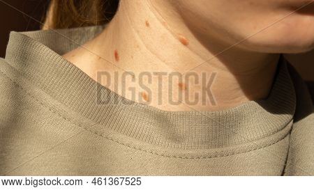 Birthmarks On Skin Close Up Detail Of The Bare Skin Sun Exposure Effect On Skin, Health Effects Of U