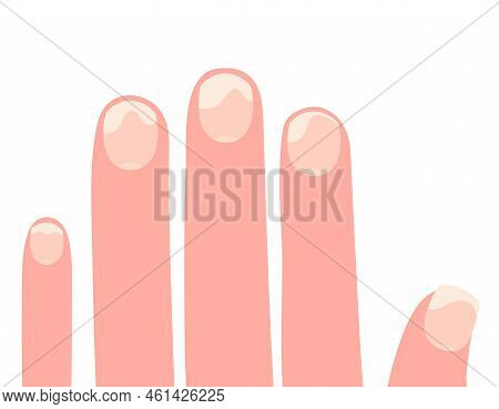 Fingers Of The Left Hand With Affected Nails Cartoon Vector Illustration Isolated On A White Backgro