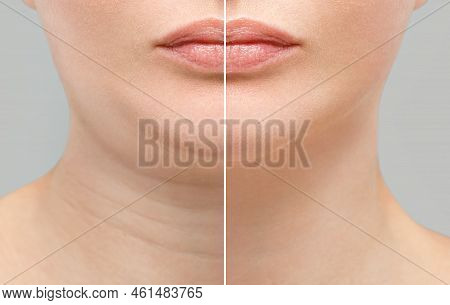 Female Double Chin Before And After Correction. Correction Of The Chin Shape Liposuction Of The Neck