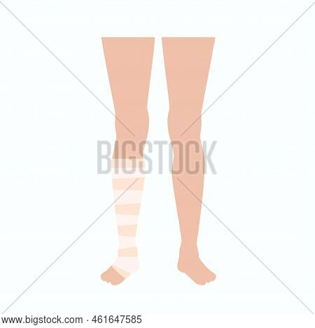 Elastic Bandage On Human Leg. Roll And Wrap Medical Gauze Over A Foot. Broken Or Injured Ankle. Heal