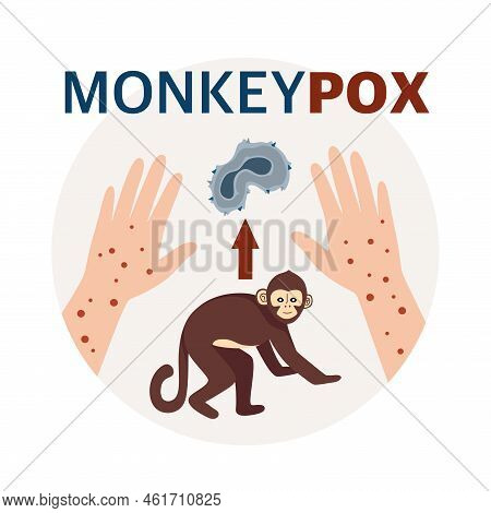 Monkey Pox Virus Poster To Inform About The Pandemic And Spread Of The Disease Images Of Human Virus