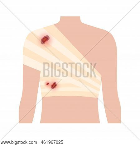 Sore, Cut Or Ulcer On Shoulder. Elastic Bandage, Medical Gauze Wrapping Over A Human Body. Broken Or