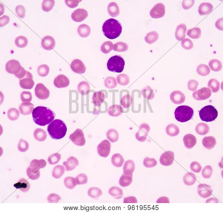 Acute Lymphoblastic Leukemia(all)