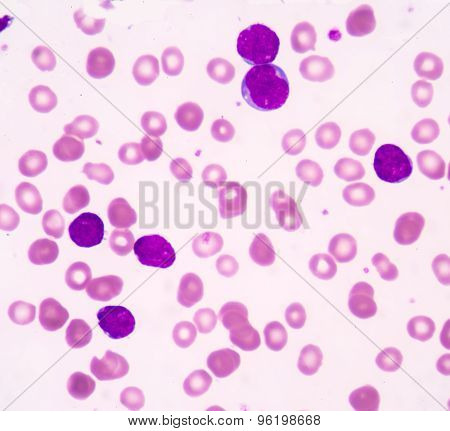 Acute Lymphoblastic Leukemia(all)