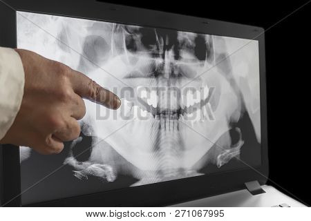 An Xray Of A Teeth With A Hand Of Doctor Witch Pointing To A Fillinged Tooth.
