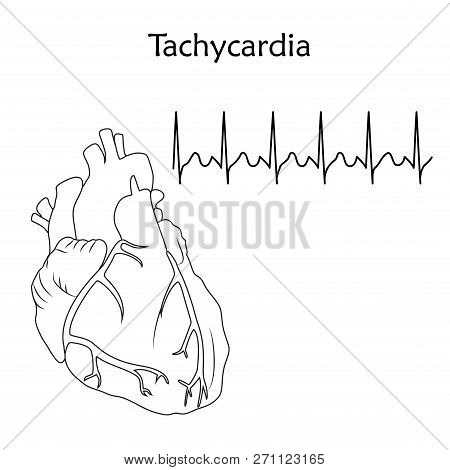 Human Heart. Tachycardia. Anatomy Flat Illustration. Outline Image, White Background. Heartbeat, Pul