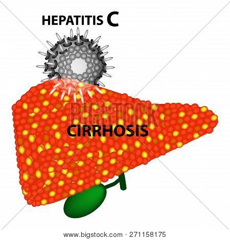 Hepatitis C Leads To The Development Of Cirrhosis In 97 Percent Of Cases. Infographics. Vector Illus