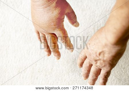 Looking Down On A Pair Of Hands, One Of Which Is Swollen Due To A Hornet Sting.close Up.