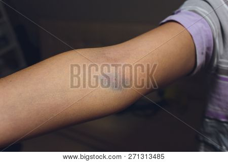 Bruises From Blood Collection Isolated. Purple Bruise On The Arm.