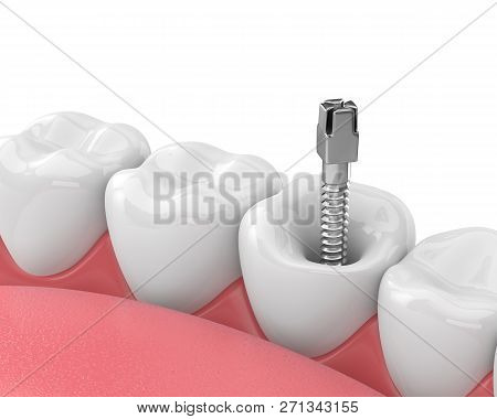 3d Render Of Jaw With Teeth And Dental Metal Post Over White. Endodontic Treatment Concept