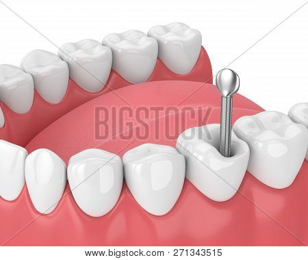 3d Render Of Jaw With Teeth And Dental Metal Post Over White. Endodontic Treatment Concept