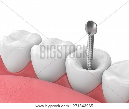 3d Render Of Jaw With Teeth And Dental Metal Post Over White. Endodontic Treatment Concept