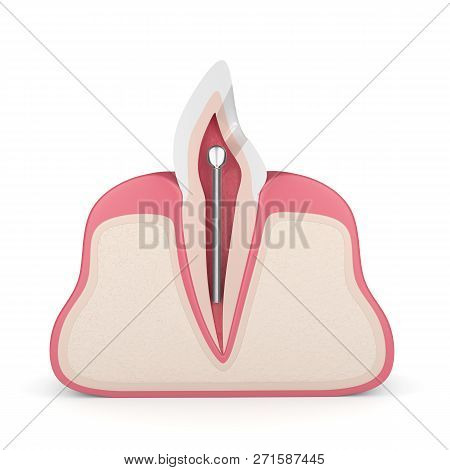3d Render Of Tooth With Dental Stainless Steel Post In Gums Over White. Endodontic Treatment Concept