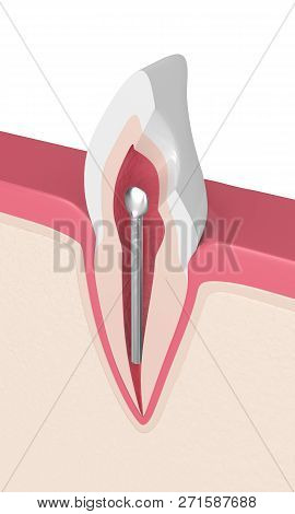 3d Render Of Tooth With Dental Stainless Steel Post In Gums. Endodontic Treatment Concept