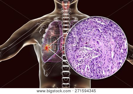 Lung Cancer, 3d Illustration And Photo Under Microscope. Light Micrograph Of Squamous Cell Carcinoma