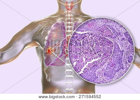 Lung Cancer, 3d Illustration And Photo Under Microscope. Light Micrograph Of Squamous Cell Carcinoma