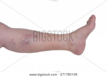 Leg Of An Elderly Woman On A White Background With Varicose Veins, Close-up, Isolate, Phlebeurysm An