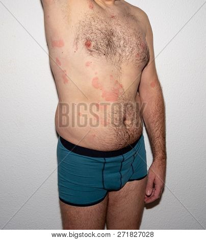 Allergy. Reaction. Histamine. Intolerance. Health