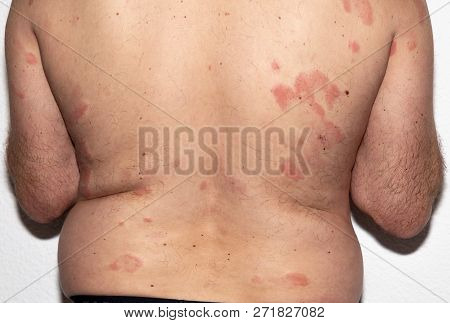Allergy. Reaction. Intolerance. Health. Histamine