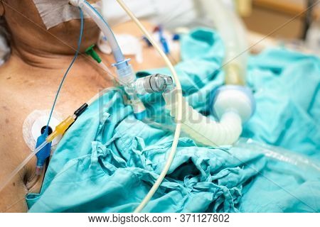 Patient Do Tracheostomy And Ventilator In Hospital