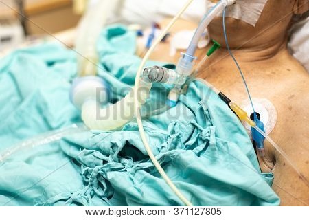 Patient Do Tracheostomy And Ventilator In Hospital
