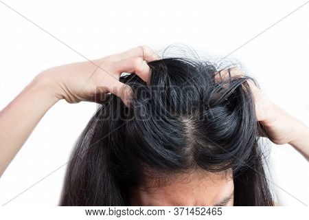 Women Head With Dandruff Caused By The Problem Of Dirty. Or Caused By Skin Disease Or Seborrheic Der
