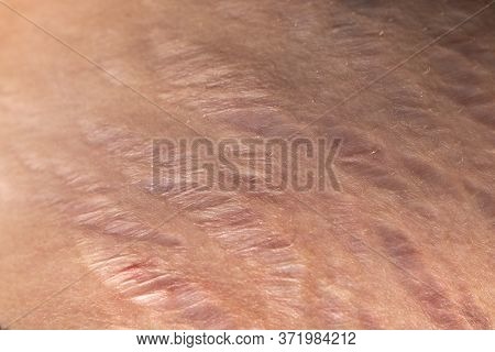Stretch Marks On The Skin Close-up. Body Scars