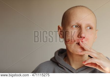 Hairless Cancer Sick Female Patient Is Bleeding From Her Nose, Effects Of Chemotherapy. Young Bald W