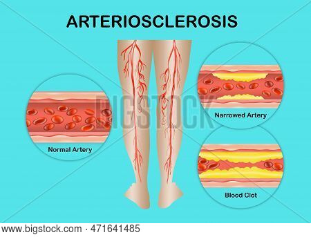 Human Legs. Artery With Blood Cells Desease. Concept Of Dry Skin, Old Senior People, Varicose Veins 