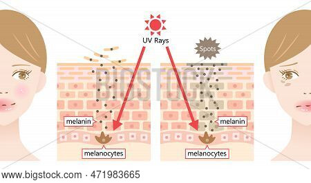 Sun's Uv Radiation Induces Dark Spot By Melanin On Young Woman's Face. Human Skin Layer And Cell Bef