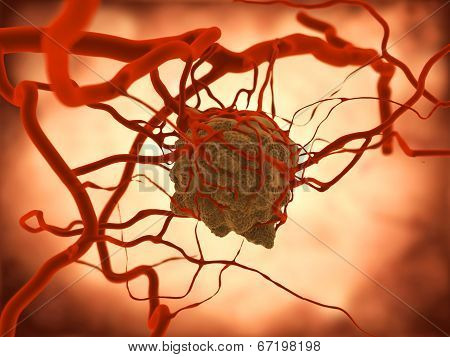 Tumor