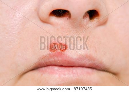 Herpes Virus