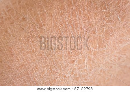 Dry Skin (ichthyosis) Detail