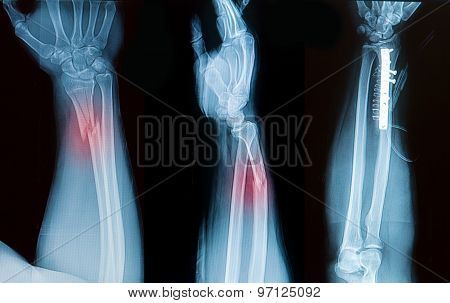 X-ray Image Of Borken Forearm Bone Show Pre- Post Operation