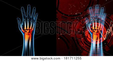 3D Rendered Anatomy Illustration - Hand Pain