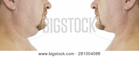 Submental Fat Man Before And After Procedures