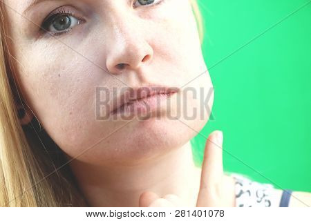 Teeth Problem. Gumboil, Flux And Swelling Of The Cheek. Closeup Of Beautiful Sad Girl Suffering From