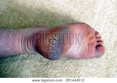 Human Heel Crack, Foot Health Problems, Neglected Heel Of A Human, Cracked Heels Human Foot,