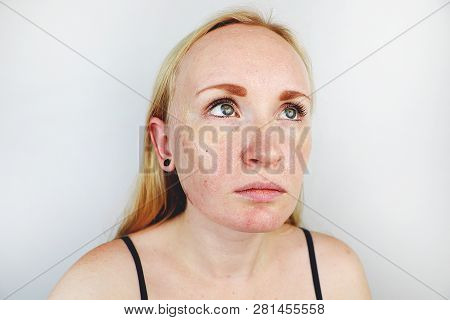 Oily And Problem Skin. Portrait Of A Blonde Girl With Acne, Oily Skin And Pigmentation
