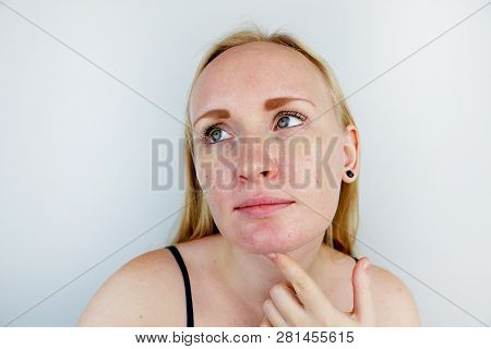 Oily And Problem Skin. Portrait Of A Blonde Girl With Acne, Oily Skin And Pigmentation