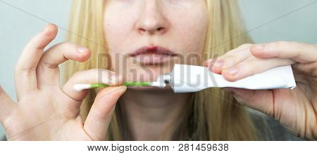 A Woman Puts On The Lips Ointment From Herpes