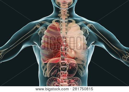 Pneumonia Medical Concept, 3d Illustration Showing Lobar Pneumonia Of The Right Lung In The Phase Of