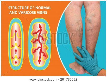 Varicose Veins On A Female Senior Legs. The Structure Of Normal And Varicose Veins. Concept Of Dry S